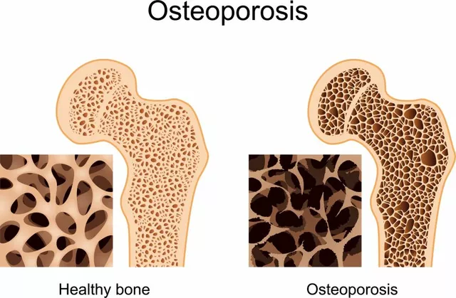 Osteoporosis and Glucocorticoids: What You Need to Know